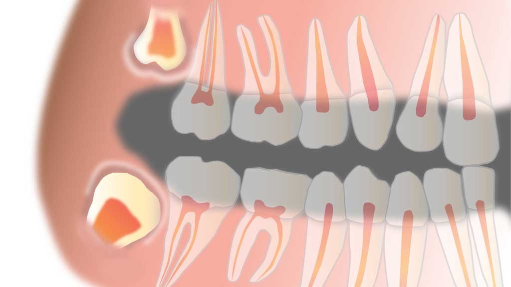 wisdom teeth